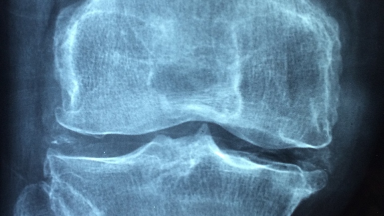 Osteoporoza: co warto wiedzieć?